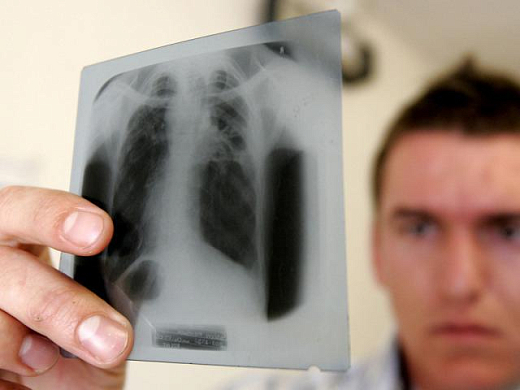 Ситуация по заболеваемости населения туберкулезом в Пензенской области имеет тенденцию к стабилизации