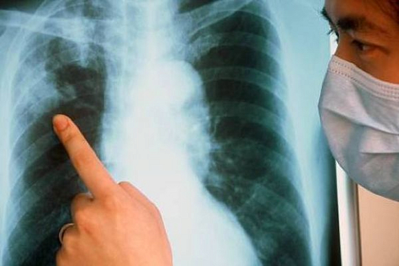 В Пензенской области на 18% снизилась заболеваемость туберкулезом